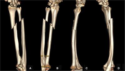 Hybrid fixation with ESIN for both bone forearm fractures in adults: A case report and literature review